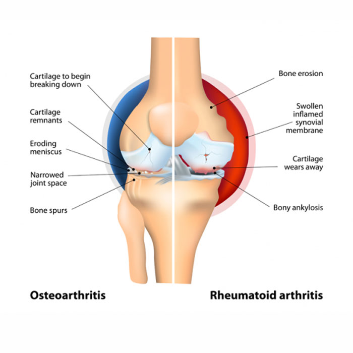 Arthritis Treatment in Baramati | Sushila Hospital