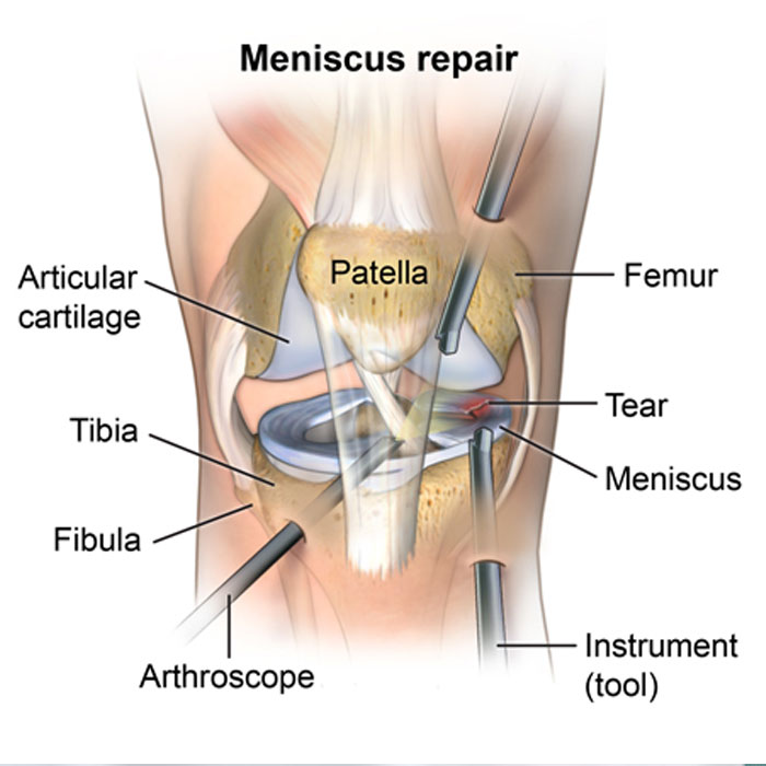 Arthroscopy Surgery in Baramati | Sushila Accident Hospital