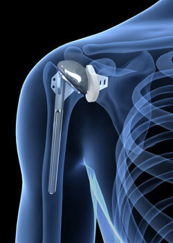 Joint Replacement Surgery in Baramati | Sushila Hospital