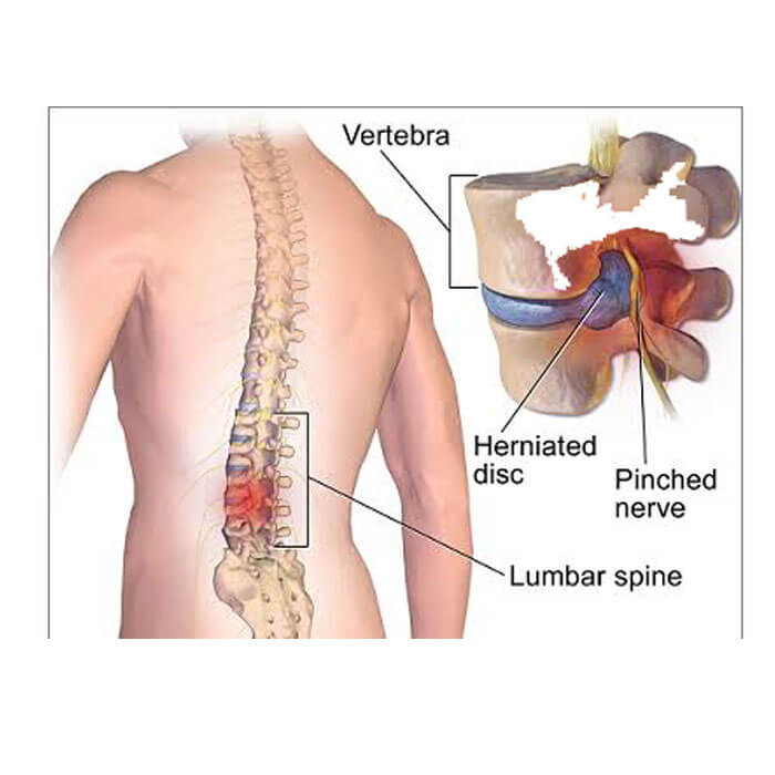 Spine Surgery, Treatment Hospital in Baramati