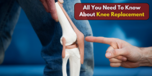 Knee Replacement Surgery in Baramati